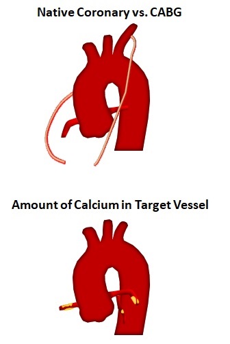Native Coronary vs. CABG Amount of Calcium in Target Vessel